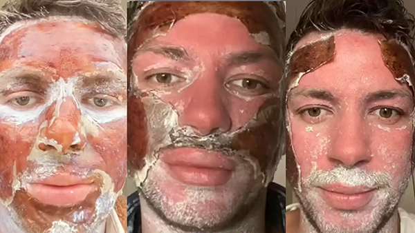 fases del cambio de piel en un peeling profundo